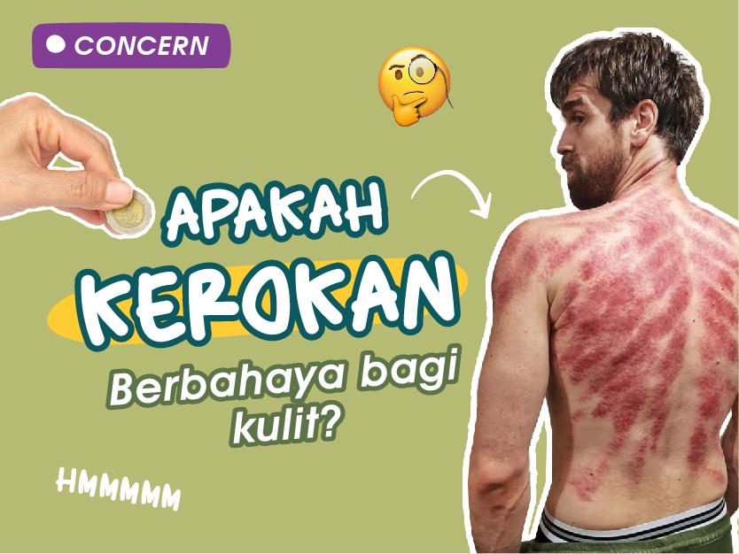 Bukan Hanya Mitos Tapi Fakta , 6 Manpaat Kerokan Bagi Tubuh,Yuk Simak Apa Saja Manpaat Nya !