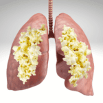 Bukan Sejenis Makanan! Kenali Apa Itu Popcorn Lung yang Dapat Mengintai Saluran Pernapasan