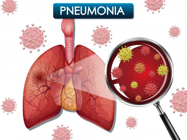 Pneumonia/agm medica