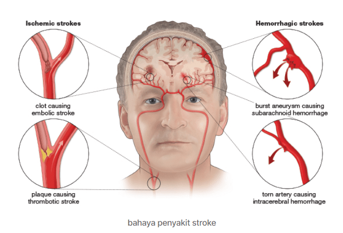 Jangan Sampai Kena Serangan Stroke Kedua Yang Bisa Menyebakan Kematian,Ini Dia Bahaya Penyakit Stroke !