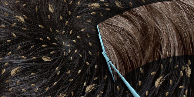 Berantas 5 Cara Menghilangkan Kutu Rambut dan Telurnya ! Dijamin Ilang.