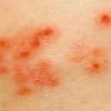 Waspada Penyakit Herpes, Menular dan Mematikan saat Musim Kemarau dan Angin Kencang