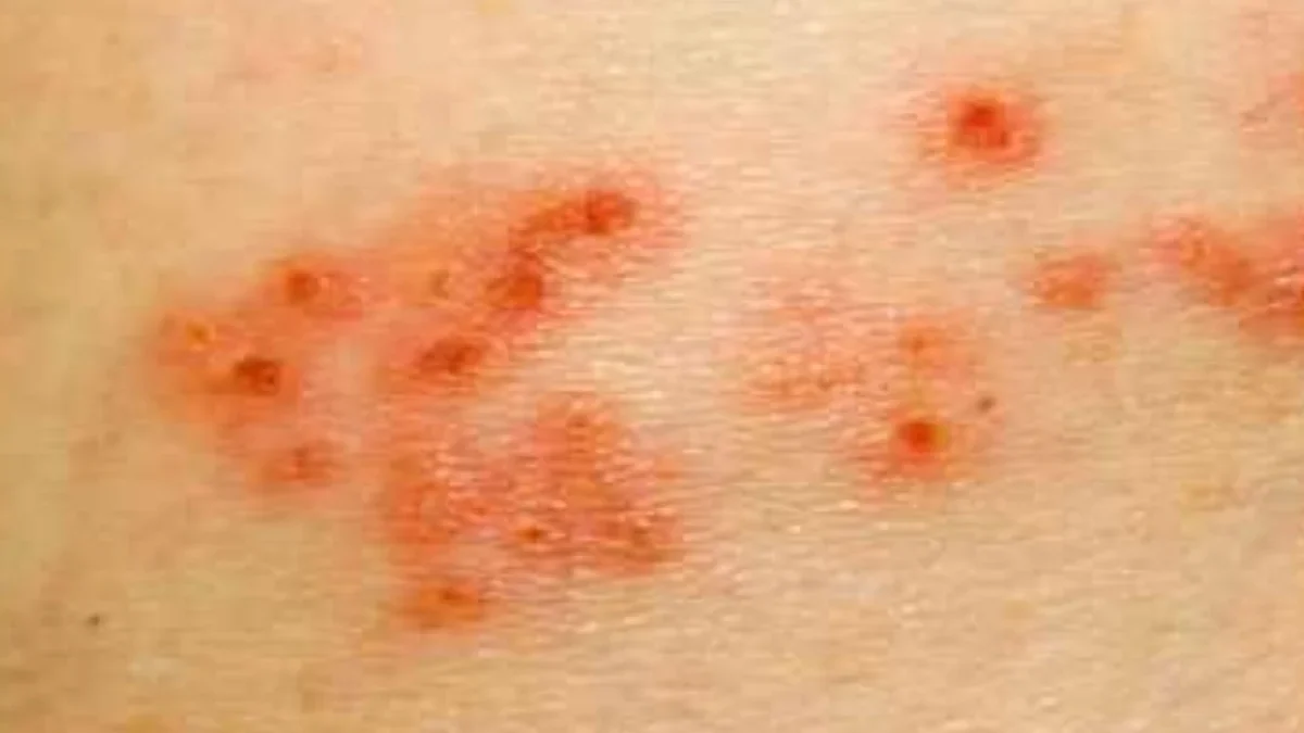 Waspada Penyakit Herpes, Menular dan Mematikan saat Musim Kemarau dan Angin Kencang