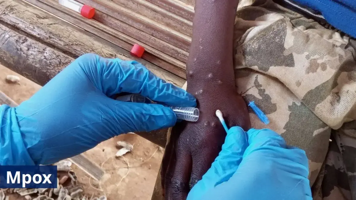 wabah Mpox