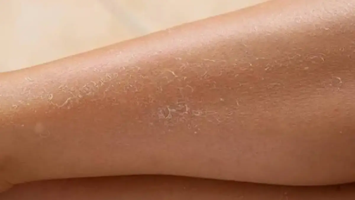 Kulit Kering Tak Lagi Menakutkan: 7 Buah Super yang Bisa Melembapkan Kulit dari Dalam Tubuh Kulit Kering